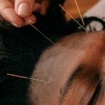 Acupuncture in Miami: Science, Philosophy, and Effective Therapy at AestheteMed