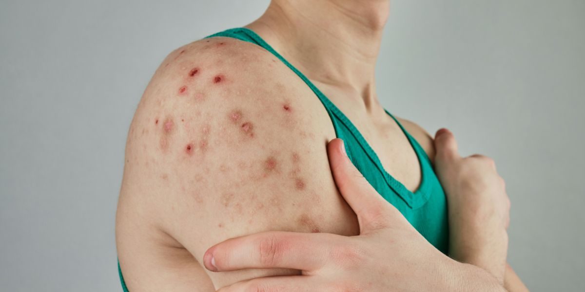 The U.S. Measles Outbreak Is Now One of the Worst in a Generation — and Elimination Status Is at Risk